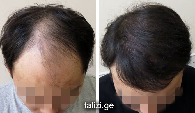 how to regrow hair after pulling it out